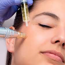 Exosomas + Microneedling