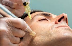 Exosomas + Microneedling