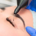Plasma Pen o Fibroblast