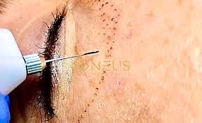 Plasma Pen o Fibroblast