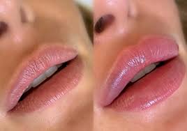 Hidra Lips